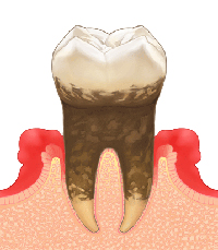 中度の歯周炎のイラスト